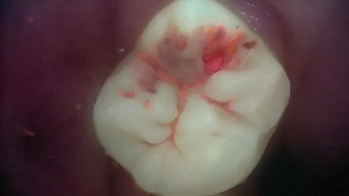 같은 어금니의 QLF 형광 촬영 예시, 붉은 형광이 보이는 부위 — 제조사 제공 자료