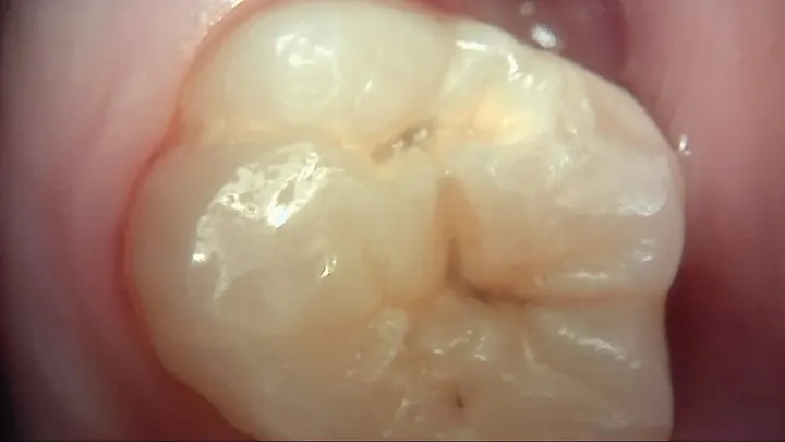 어금니 표면 일반 촬영 예시 — 제조사 제공 자료